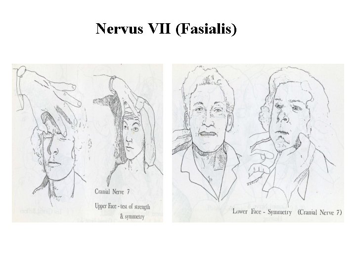 Nervus VII (Fasialis) 