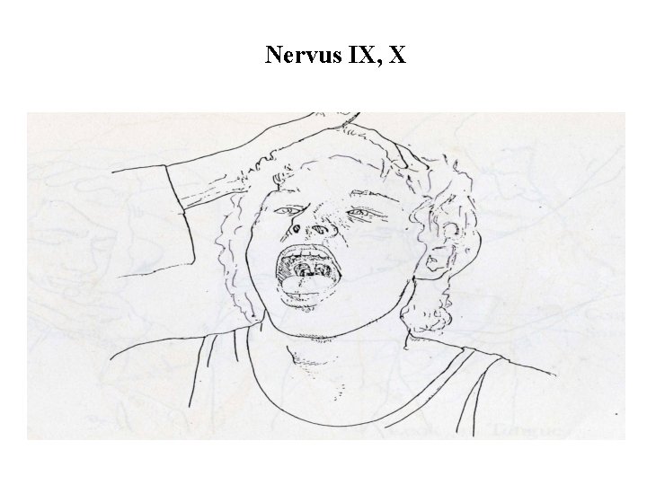Nervus IX, X 