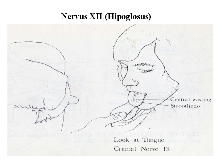 Nervus XII (Hipoglosus) 