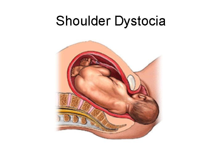 Shoulder Dystocia 