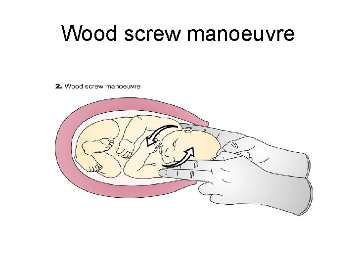 Wood screw manoeuvre 