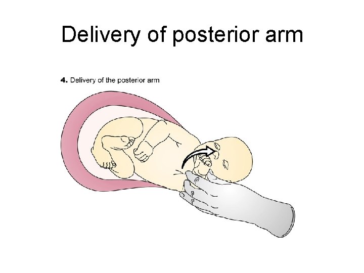 Delivery of posterior arm 