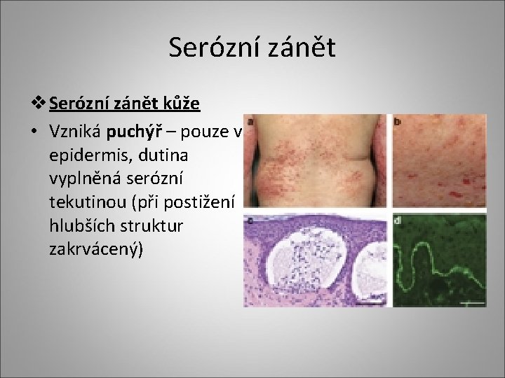 Serózní zánět v Serózní zánět kůže • Vzniká puchýř – pouze v epidermis, dutina