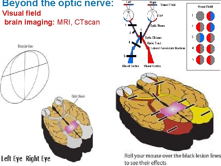 Beyond the optic nerve: Visual field brain imaging: MRI, CTscan 