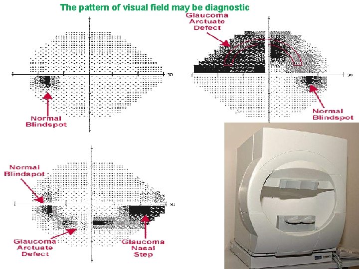 The pattern of visual field may be diagnostic 