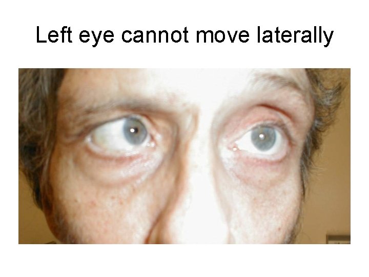 Left eye cannot move laterally 