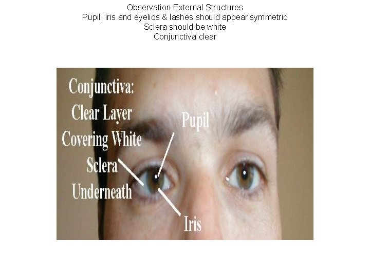 Observation External Structures Pupil, iris and eyelids & lashes should appear symmetric Sclera should