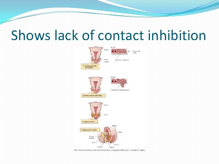 Shows lack of contact inhibition 