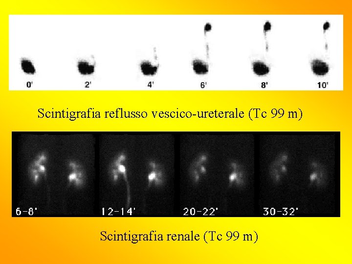 Scintigrafia reflusso vescico-ureterale (Tc 99 m) Scintigrafia renale (Tc 99 m) 