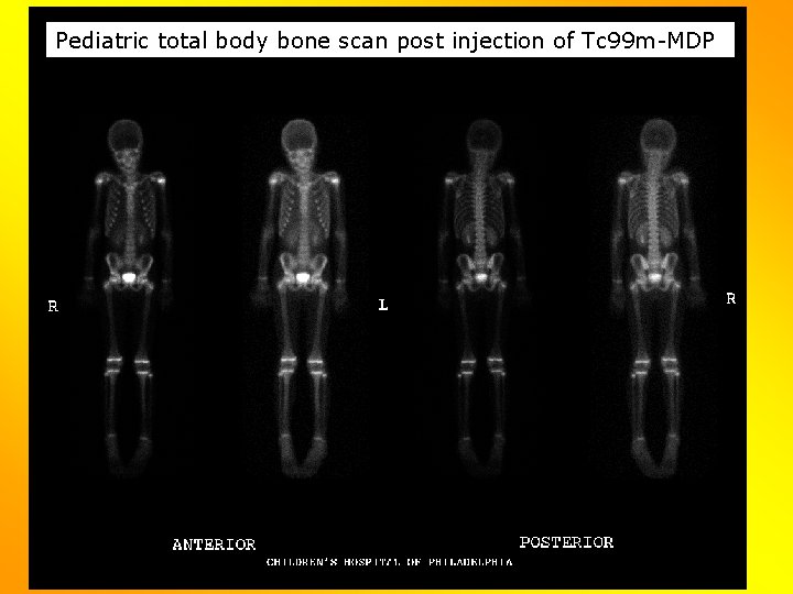 Pediatric total body bone scan post injection of Tc 99 m-MDP Pediatric total body bone scan post injection of Tc 99 m-MDP