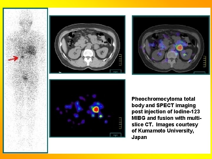 Pheochromocytoma total body and SPECT imaging post injection of Iodine-123 MIBG and fusion with