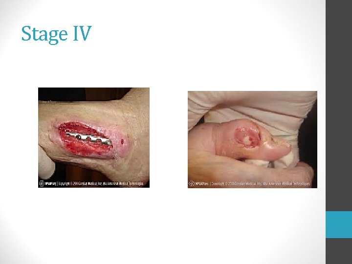 Stage IV 