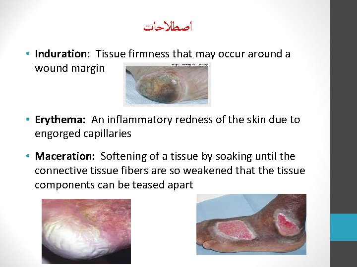  ﺍﺻﻄﻼﺣﺎﺕ • Induration: Tissue firmness that may occur around a wound margin •