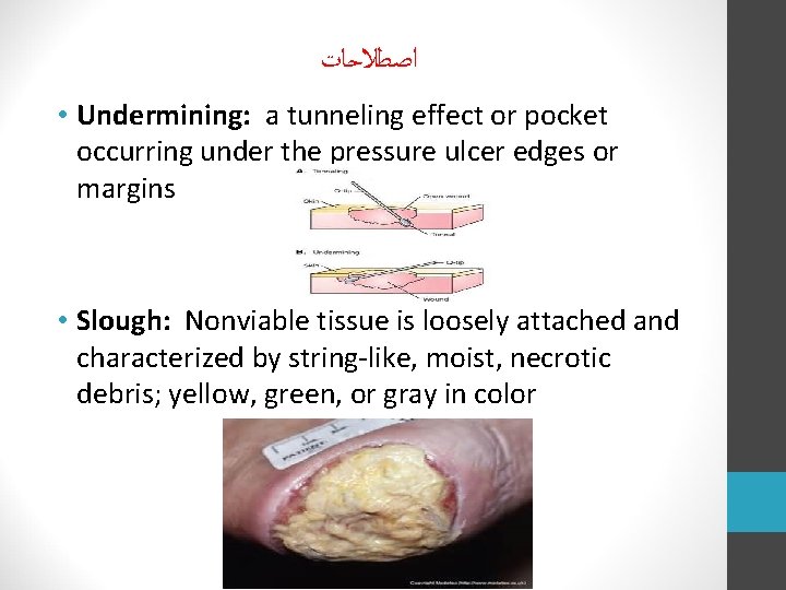  ﺍﺻﻄﻼﺣﺎﺕ • Undermining: a tunneling effect or pocket occurring under the pressure ulcer