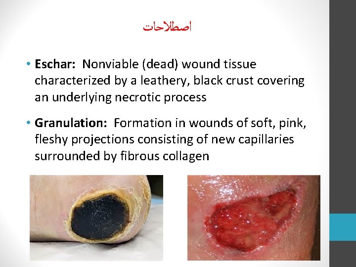  ﺍﺻﻄﻼﺣﺎﺕ • Eschar: Nonviable (dead) wound tissue characterized by a leathery, black crust