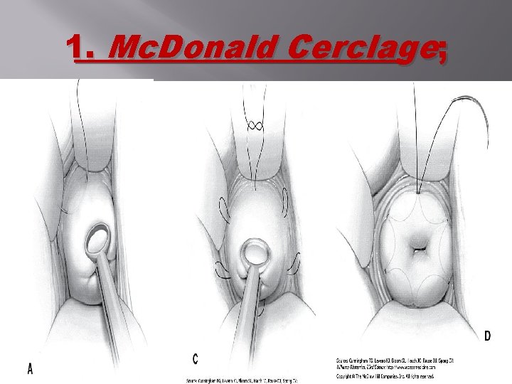 1. Mc. Donald Cerclage; 1. Mc. Donald Cerclage;