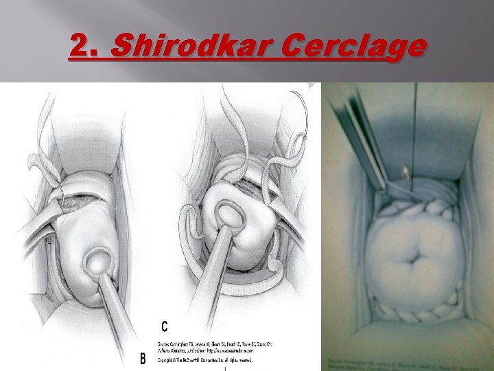 2. Shirodkar Cerclage 2. Shirodkar Cerclage
