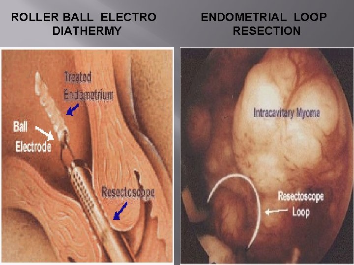 ROLLER BALL ELECTRO DIATHERMY ENDOMETRIAL LOOP RESECTION ROLLER BALL ELECTRO DIATHERMY ENDOMETRIAL LOOP RESECTION