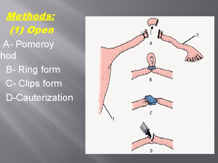 Methods: (1) Open A- Pomeroy thod B- Ring form C- Clips form D-Cauterization Methods: (1) Open A- Pomeroy thod B- Ring form C- Clips form D-Cauterization