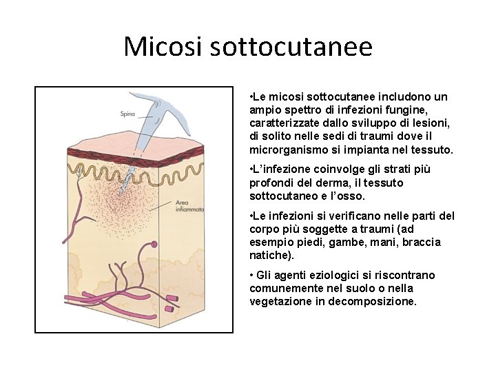 Micosi sottocutanee • Le micosi sottocutanee includono un ampio spettro di infezioni fungine, caratterizzate Micosi sottocutanee • Le micosi sottocutanee includono un ampio spettro di infezioni fungine, caratterizzate