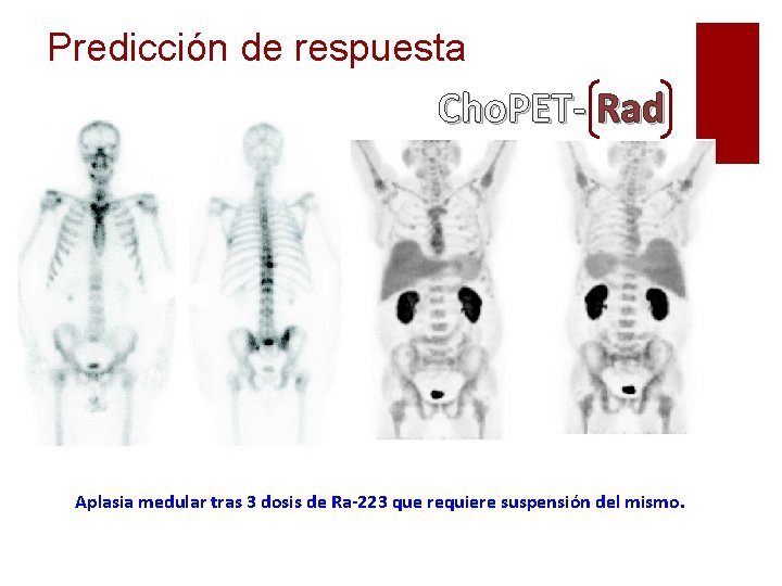 Predicción de respuesta Cho. PET- Rad Aplasia medular tras 3 dosis de Ra-223 que Predicción de respuesta Cho. PET- Rad Aplasia medular tras 3 dosis de Ra-223 que