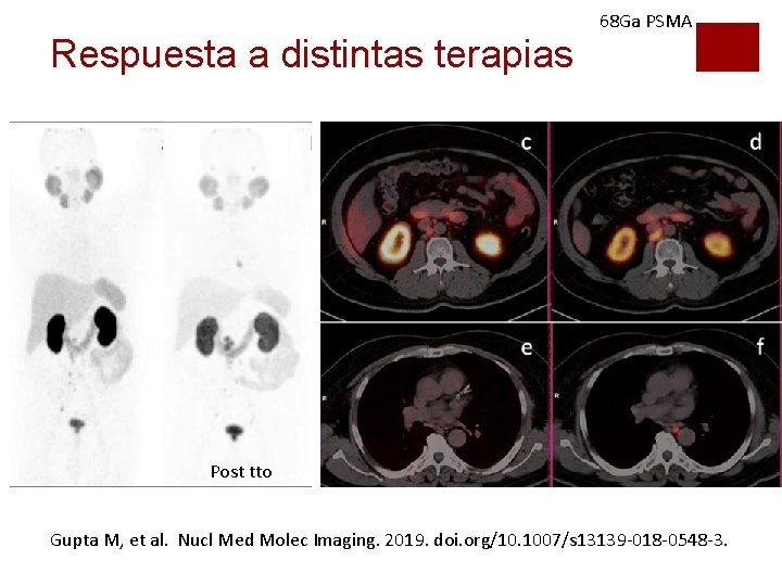 Respuesta a distintas terapias 68 Ga PSMA Post tto Gupta M, et al. Nucl Respuesta a distintas terapias 68 Ga PSMA Post tto Gupta M, et al. Nucl
