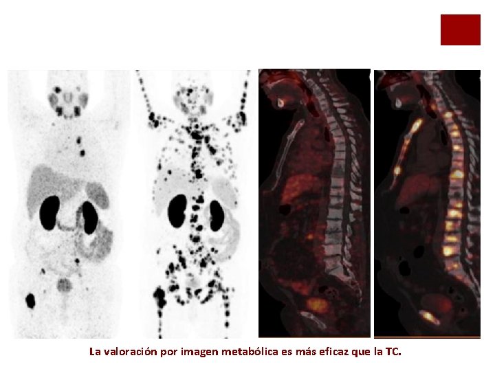 La valoración por imagen metabólica es más eficaz que la TC. La valoración por imagen metabólica es más eficaz que la TC.