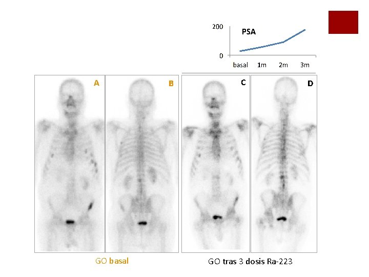 A GO basal B C GO tras 3 dosis Ra-223 D A GO basal B C GO tras 3 dosis Ra-223 D