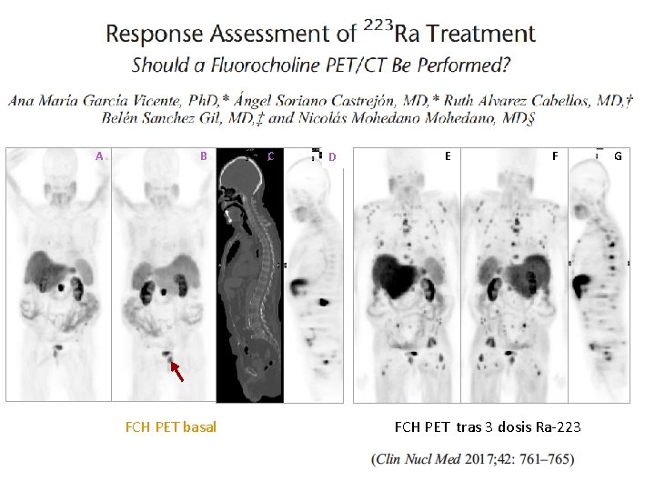 A B FCH PET basal C D E F FCH PET tras 3 dosis A B FCH PET basal C D E F FCH PET tras 3 dosis