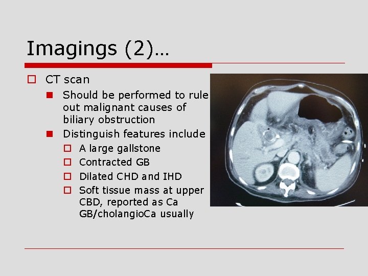 Imagings (2)… o CT scan n Should be performed to rule out malignant causes