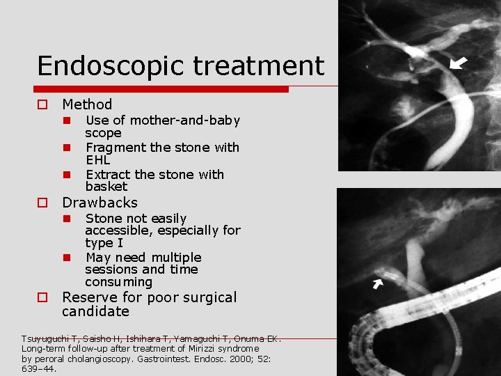 Endoscopic treatment o Method n n n Use of mother-and-baby scope Fragment the stone
