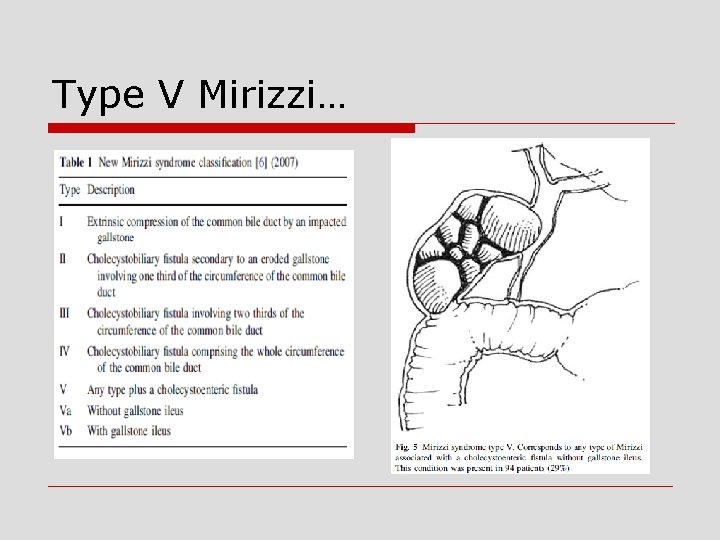 Type V Mirizzi… 