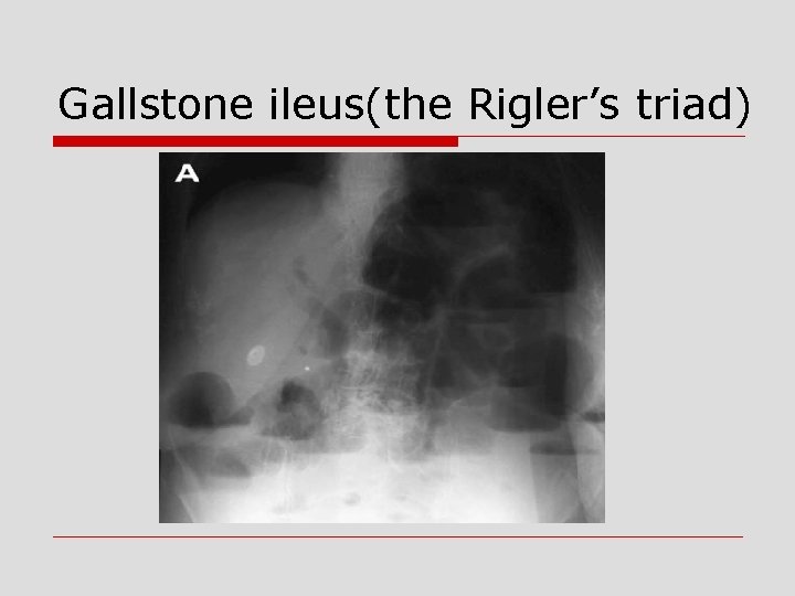 Gallstone ileus(the Rigler’s triad) 