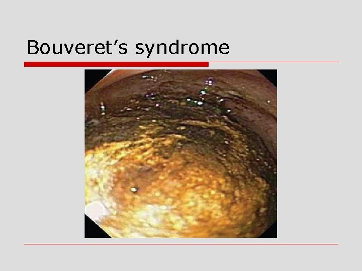 Bouveret’s syndrome 