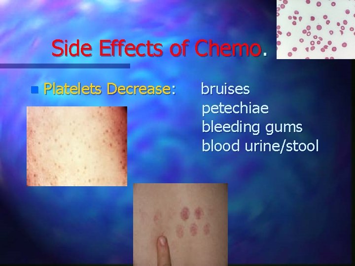 Side Effects of Chemo. n Platelets Decrease: bruises petechiae bleeding gums blood urine/stool 