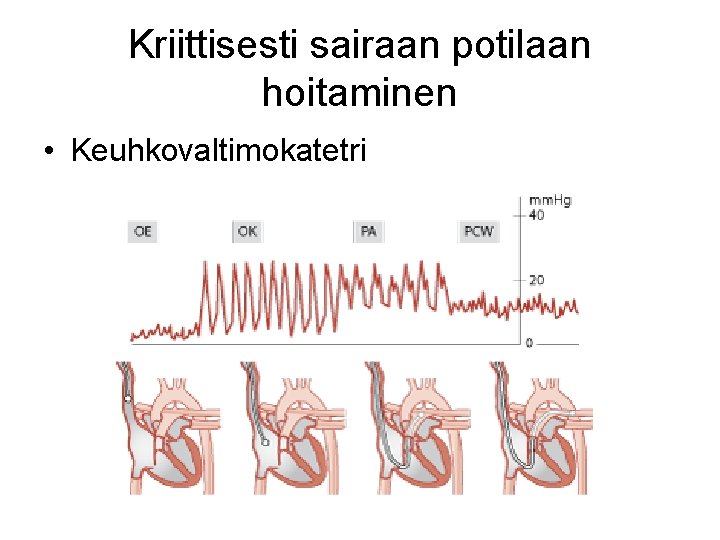 Kriittisesti sairaan potilaan hoitaminen • Keuhkovaltimokatetri 