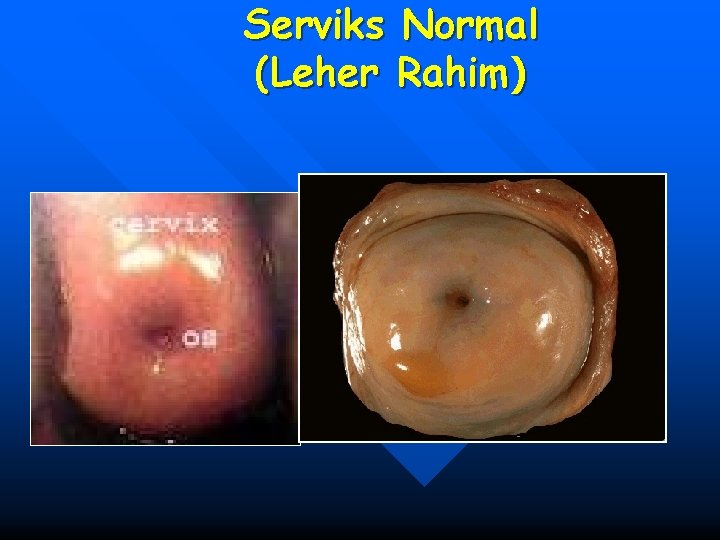 Serviks Normal (Leher Rahim) 