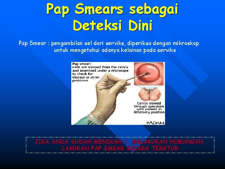 Pap Smears sebagai Deteksi Dini Pap Smear : pengambilan sel dari serviks, diperiksa dengan