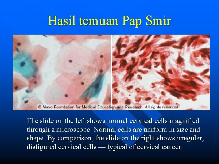 Hasil temuan Pap Smir The slide on the left shows normal cervical cells magnified