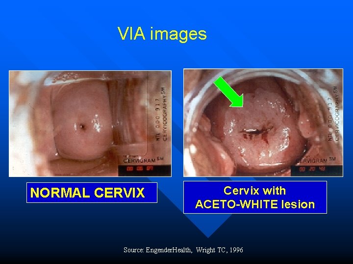 VIA images NORMAL CERVIX Cervix with ACETO-WHITE lesion Source: Engender. Health, Wright TC, 1996