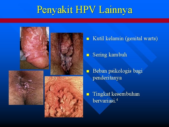 Penyakit HPV Lainnya n Kutil kelamin (genital warts) n Sering kambuh n Beban psikologis