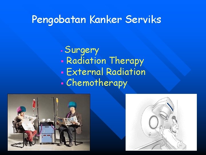 Pengobatan Kanker Serviks Surgery § Radiation Therapy § External Radiation § Chemotherapy § 