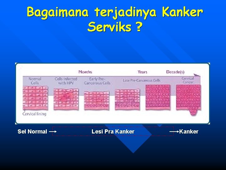 Bagaimana terjadinya Kanker Serviks ? Sel Normal Lesi Pra Kanker 