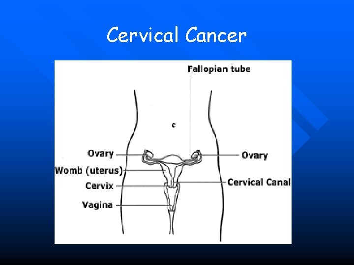 Cervical Cancer 