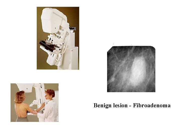 Benign lesion - Fibroadenoma 