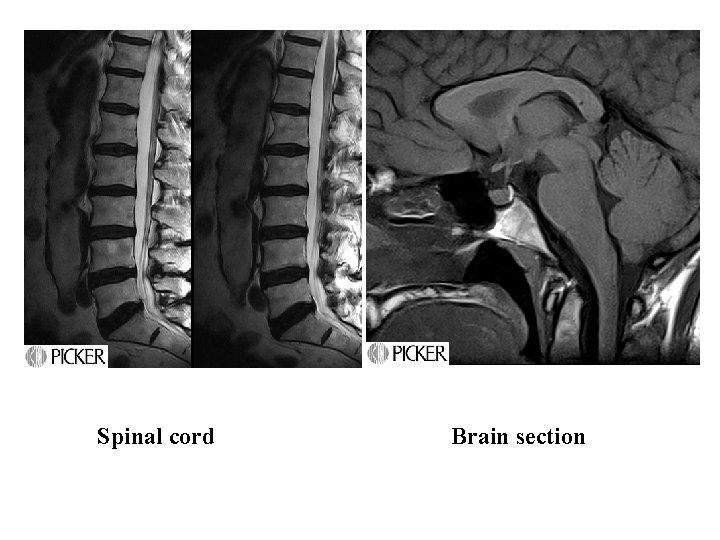 Spinal cord Brain section 