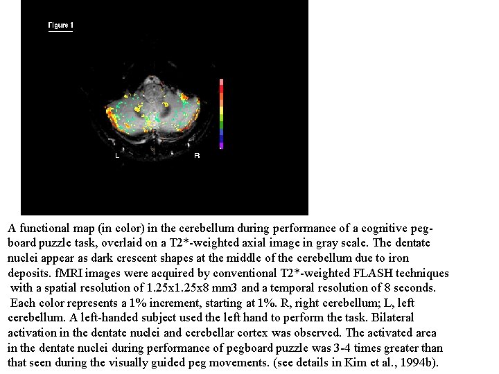 A functional map (in color) in the cerebellum during performance of a cognitive pegboard