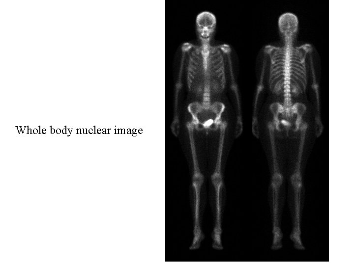 Whole body nuclear image 