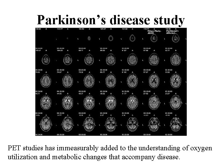 Parkinson’s disease study PET studies has immeasurably added to the understanding of oxygen utilization