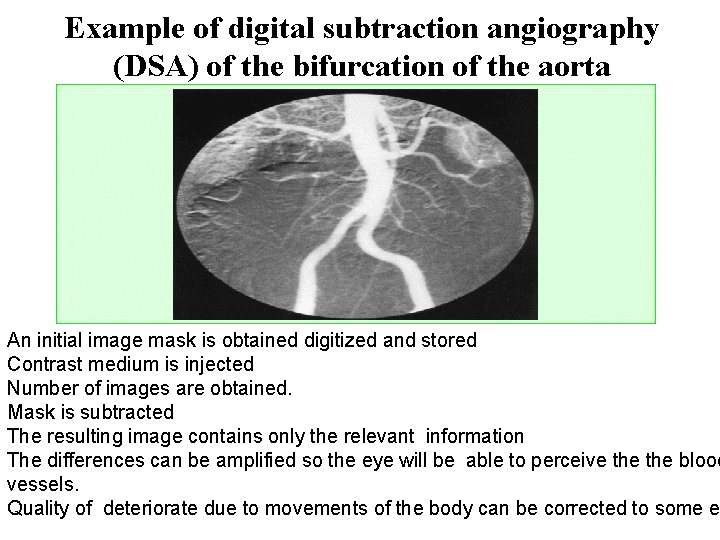 Example of digital subtraction angiography (DSA) of the bifurcation of the aorta An initial